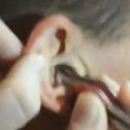  Woman Pulls HUGE Lump of Earwax From Man’s Ear